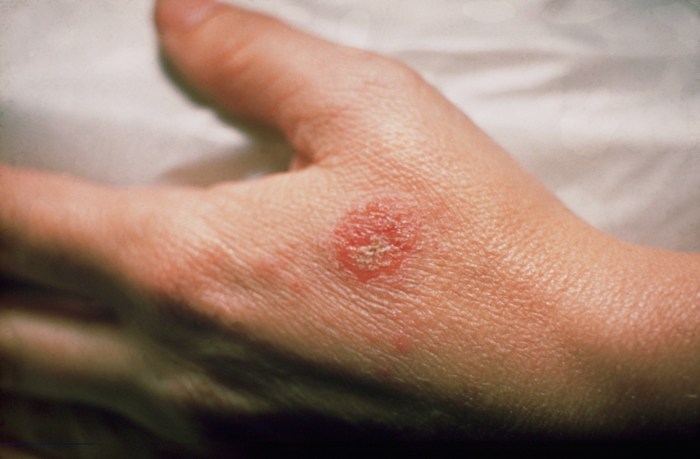 Eczema and allergies