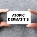 Atopic dermatitis