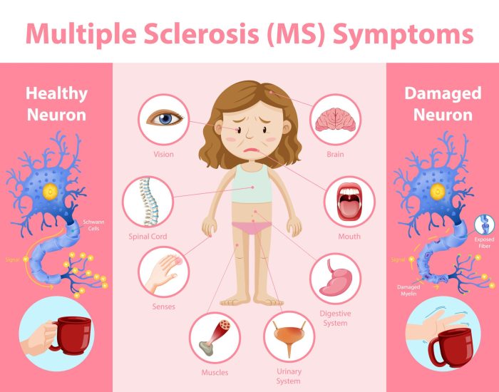 Sclerosis multiple symptoms main illustration Sclerosis multiple symptoms main illustration