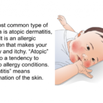 Eczema and allergies