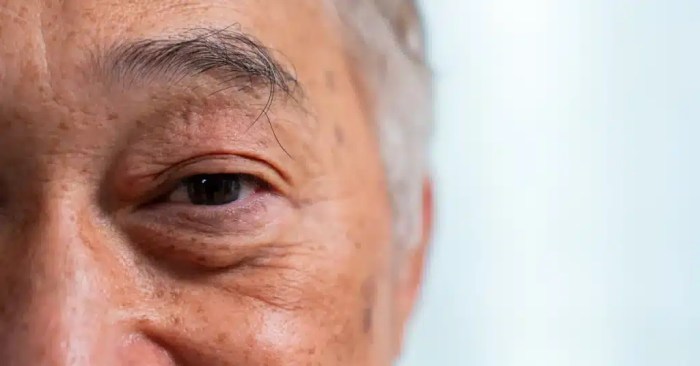 Cataract cataracts treatments what vision glaucoma richardson md david cure treatment permanent norland vitale options blurred surgery effective nairaland recovery Cataract cataracts treatments what vision glaucoma richardson md david cure treatment permanent norland vitale options blurred surgery effective nairaland recovery